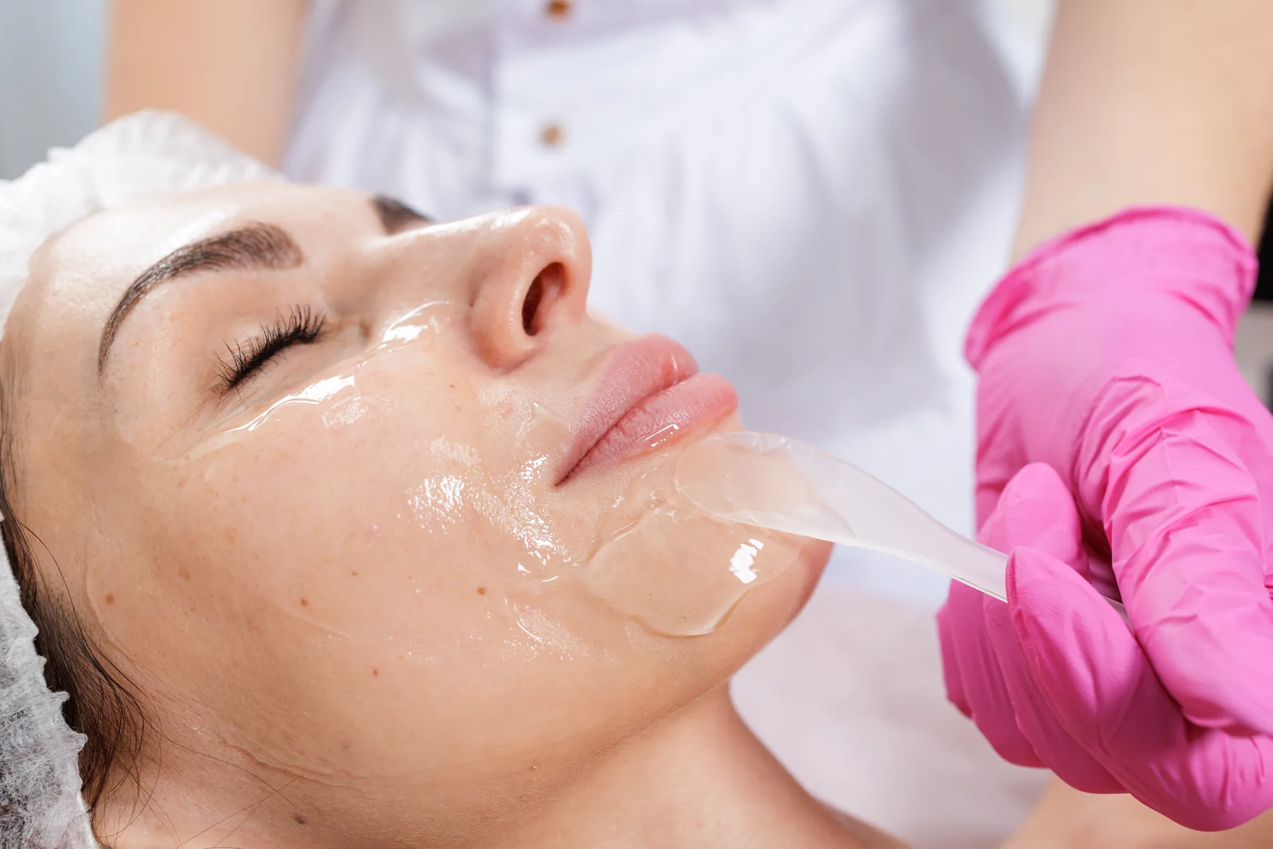 Chemical peel treatment at SOLAÉ